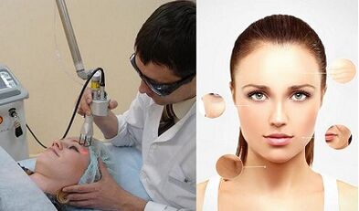 តើការស្តារស្បែកឡើងវិញដោយឡាស៊ែរត្រូវបានអនុវត្តយ៉ាងដូចម្តេច